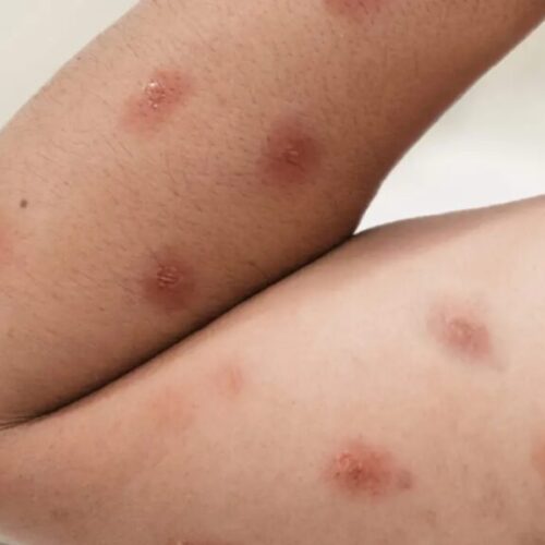 “Descubra como se prevenir da Mpox, doença que já afetou 88 pessoas no Brasil em 2026”