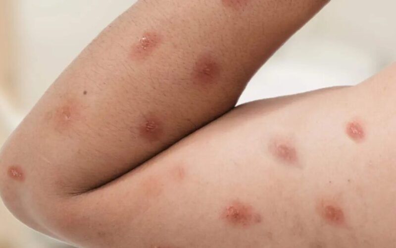 “Descubra como se prevenir da Mpox, doença que já afetou 88 pessoas no Brasil em 2026”